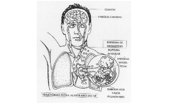 ohb-rio.medicina,medicina hiperbárica,hiperbárica,oxigênioterapia,madicina ocupacional,doenças descompressívas,embilia,dr. Tomaz Brito,baurotraumas,edema pulmonar,terapia,camara,esquemia,queimadura,aso,infecção,infecções