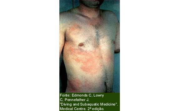 ohb-rio.medicina,medicina hiperbárica,hiperbárica,oxigênioterapia,madicina ocupacional,doenças descompressívas,embilia,dr. Tomaz Brito,baurotraumas,edema pulmonar,terapia,camara,esquemia,queimadura,aso,infecção,infecções