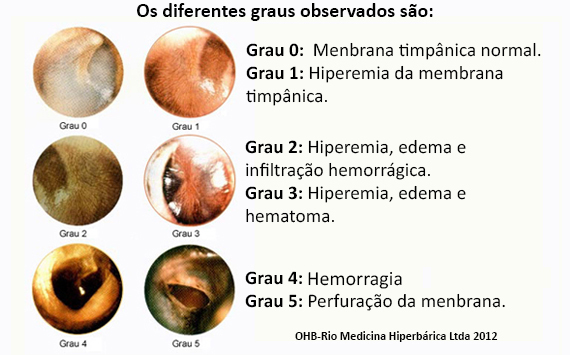 ohb-rio.medicina,medicina hiperbárica,hiperbárica,oxigênioterapia,madicina ocupacional,doenças descompressívas,embilia,dr. Tomaz Brito,baurotraumas,edema pulmonar,terapia,camara,esquemia,queimadura,aso,infecção,infecções